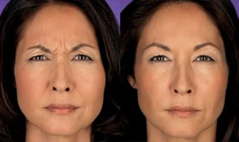 botox-before-and-after bellevue | seattle