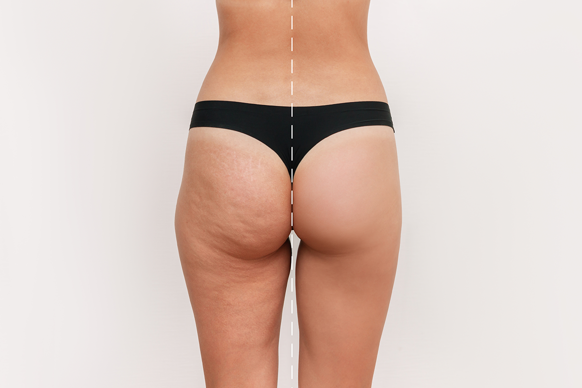 Woman's thighs and buttocks with cellulite before and after treatment