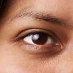 >Blepharoplasty (droopy eyelids) Bellevue WA