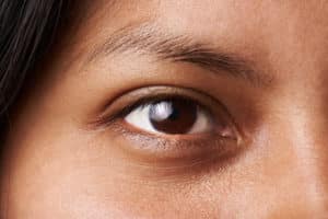 >Blepharoplasty (droopy eyelids) Bellevue WA