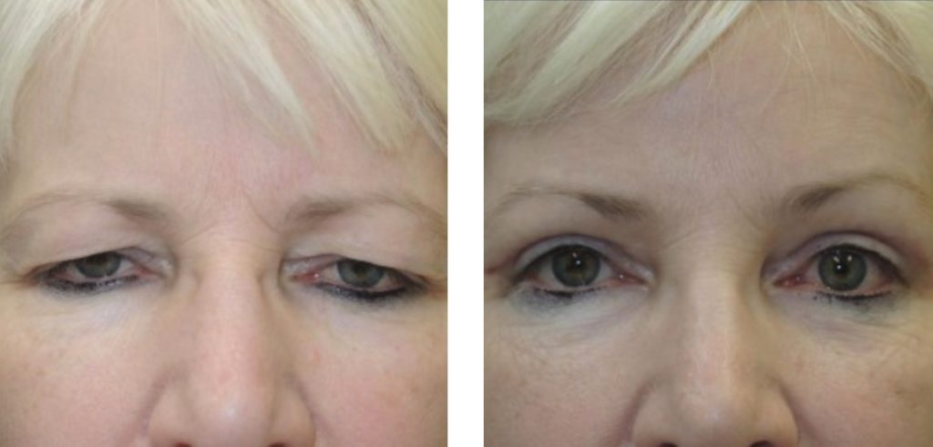 Before and After Blepharoplasty | Kristin Tarbet, MD | Bellevue, WA
