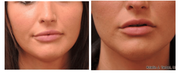 woman’s lips before and after Juvéderm lip fillers, more plump and full after procedure
