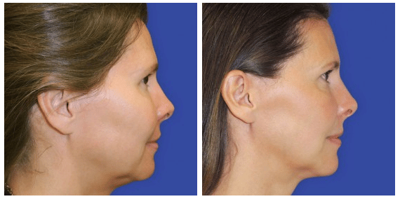 woman before and Kybella injections, chin more defined after treatment