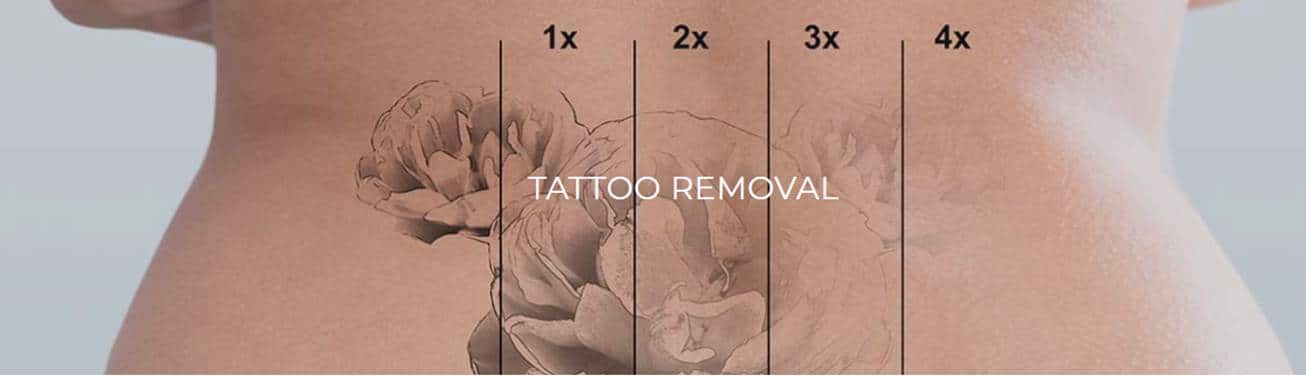 Tattoo Removal Bellevue WA | Laser Tattoo Removal Seattle WA