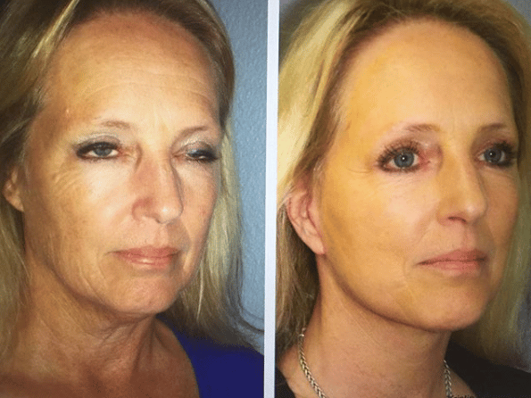 middle-aged woman before and after facelift surgery, face rejuvenated and eyelids less droopy after procedures