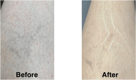 A before and after image of a person who underwent an excel v laser treatment by Dr. Tarbet. 