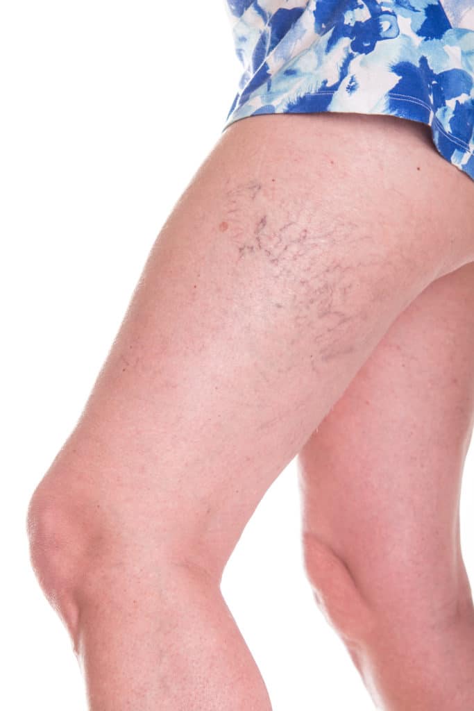 an example of and individual with spider veins.