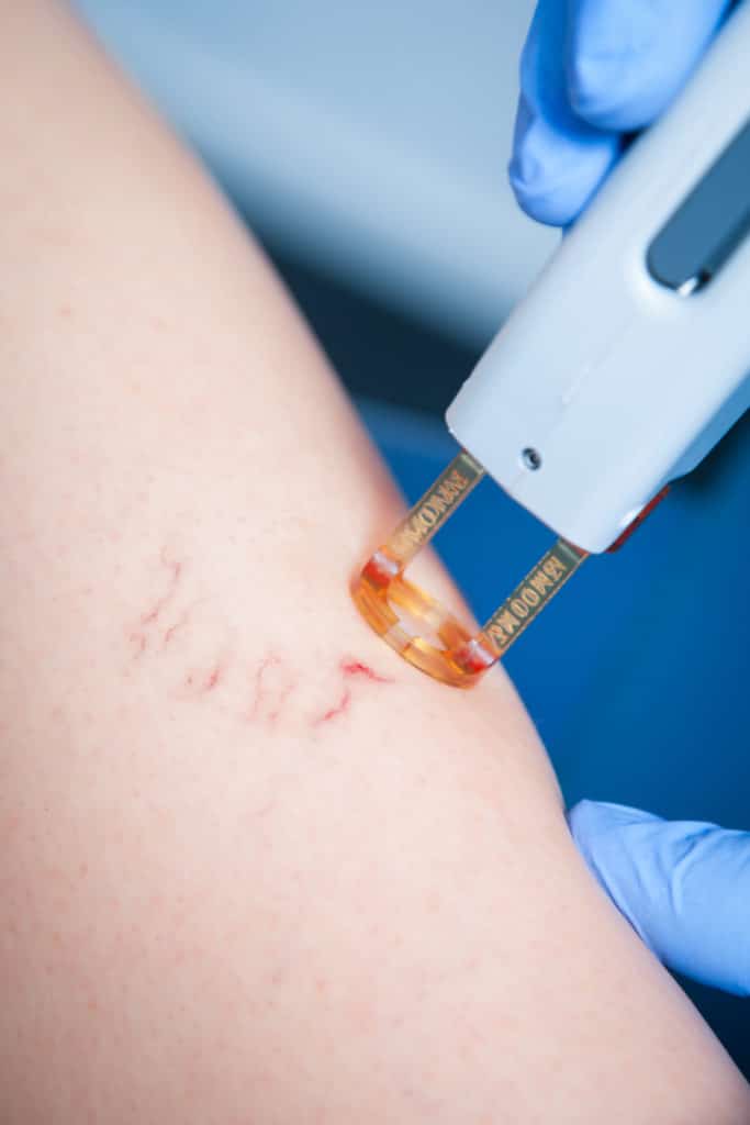 Treatment of spider veins with the excel v laser. 