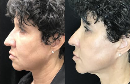 Morpheus8 before and after photo by Kristin J. Tarbet, M.D. in Bellevue, WA