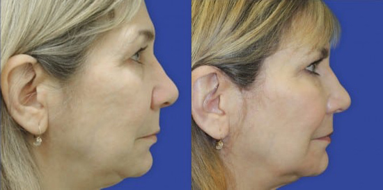 Sculptra before and after photo by Kristin J. Tarbet, M.D. in Bellevue, WA