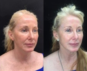 Silhouette InstaLift before and after photo by Kristin J. Tarbet, M.D. in Bellevue, WA