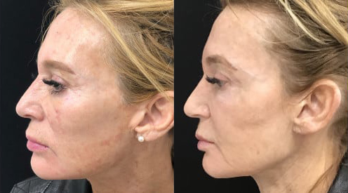 Ultherapy before and after photo by Kristin J. Tarbet, M.D. in Bellevue, WA