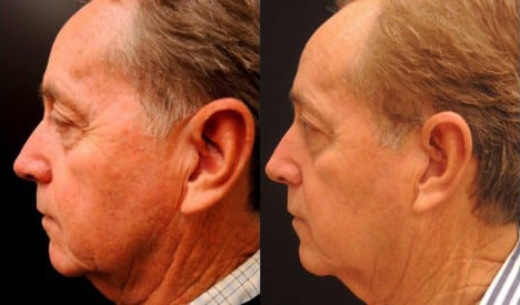 Ultherapy before and after photo by Kristin J. Tarbet, M.D. in Bellevue, WA