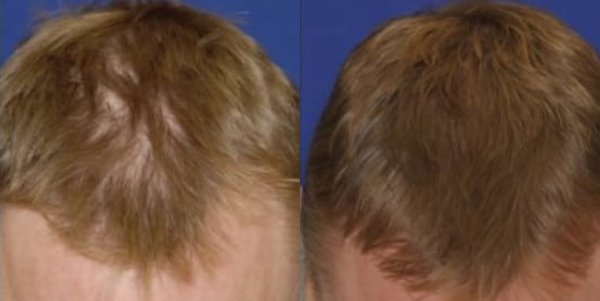 PRP hair before and after photo by Kristin J. Tarbet, M.D. in Bellevue, WA