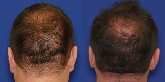 PRP hair before and after photo by Kristin J. Tarbet, M.D. in Bellevue, WA