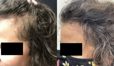 PRP hair before and after photo by Kristin J. Tarbet, M.D. in Bellevue, WA