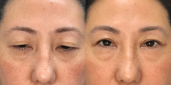 Blepharoplasty (Eyelid Surgery) before and after photo by Kristin J. Tarbet, M.D. in Bellevue, WA