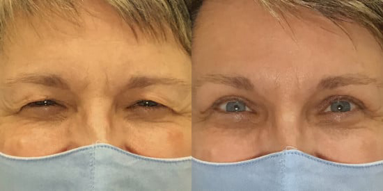 Blepharoplasty (Eyelid Surgery) before and after photo by Kristin J. Tarbet, M.D. in Bellevue, WA