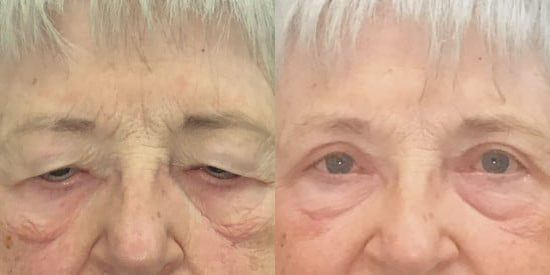 Blepharoplasty (Eyelid Surgery) before and after photo by Kristin J. Tarbet, M.D. in Bellevue, WA
