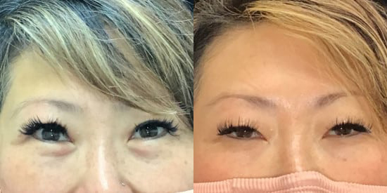 Blepharoplasty (Eyelid Surgery) before and after photo by Kristin J. Tarbet, M.D. in Bellevue, WA