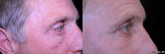 Blepharoplasty (Eyelid Surgery) before and after photo by Kristin J. Tarbet, M.D. in Bellevue, WA