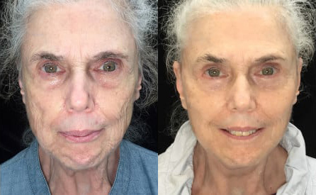 Blepharoplasty (Eyelid Surgery) before and after photo by Kristin J. Tarbet, M.D. in Bellevue, WA