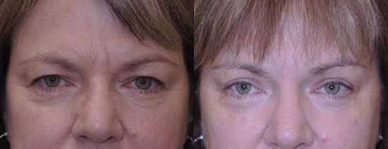 Blepharoplasty (Eyelid Surgery) before and after photo by Kristin J. Tarbet, M.D. in Bellevue, WA