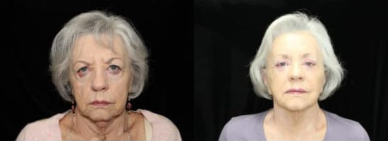 Blepharoplasty (Eyelid Surgery) before and after photo by Kristin J. Tarbet, M.D. in Bellevue, WA
