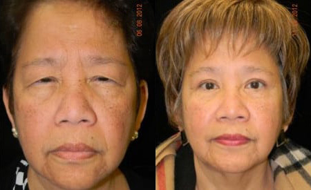 Blepharoplasty (Eyelid Surgery) before and after photo by Kristin J. Tarbet, M.D. in Bellevue, WA