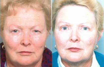 Blepharoplasty (Eyelid Surgery) before and after photo by Kristin J. Tarbet, M.D. in Bellevue, WA