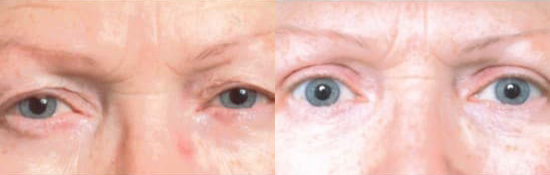 Blepharoplasty (Eyelid Surgery) before and after photo by Kristin J. Tarbet, M.D. in Bellevue, WA