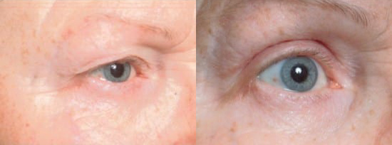 Blepharoplasty (Eyelid Surgery) before and after photo by Kristin J. Tarbet, M.D. in Bellevue, WA