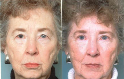 Blepharoplasty (Eyelid Surgery) before and after photo by Kristin J. Tarbet, M.D. in Bellevue, WA