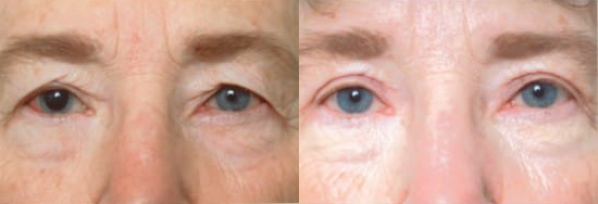 Blepharoplasty (Eyelid Surgery) before and after photo by Kristin J. Tarbet, M.D. in Bellevue, WA