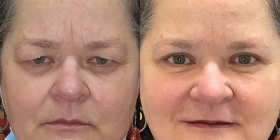 Blepharoplasty (Eyelid Surgery) before and after photo by Kristin J. Tarbet, M.D. in Bellevue, WA