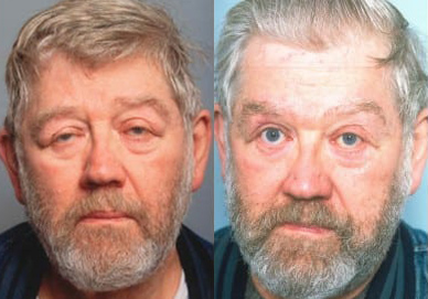 Blepharoplasty (Eyelid Surgery) before and after photo by Kristin J. Tarbet, M.D. in Bellevue, WA