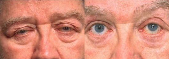 Blepharoplasty (Eyelid Surgery) before and after photo by Kristin J. Tarbet, M.D. in Bellevue, WA