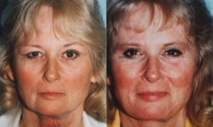 Blepharoplasty (Eyelid Surgery) before and after photo by Kristin J. Tarbet, M.D. in Bellevue, WA