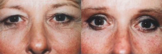 Blepharoplasty (Eyelid Surgery) before and after photo by Kristin J. Tarbet, M.D. in Bellevue, WA