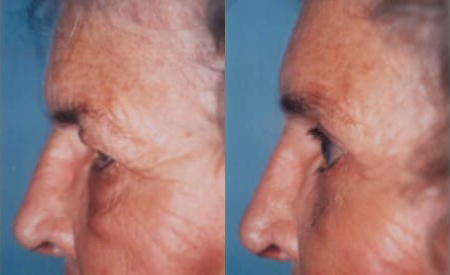 Blepharoplasty (Eyelid Surgery) before and after photo by Kristin J. Tarbet, M.D. in Bellevue, WA