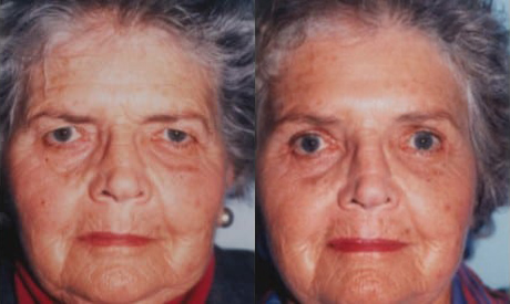 Blepharoplasty (Eyelid Surgery) before and after photo by Kristin J. Tarbet, M.D. in Bellevue, WA