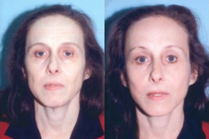 Blepharoplasty (Eyelid Surgery) before and after photo by Kristin J. Tarbet, M.D. in Bellevue, WA