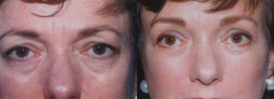 Blepharoplasty (Eyelid Surgery) before and after photo by Kristin J. Tarbet, M.D. in Bellevue, WA