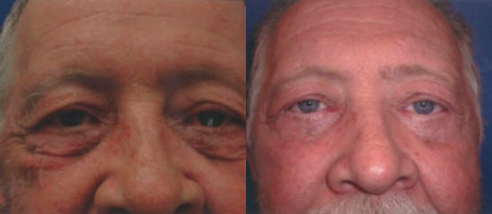 Blepharoplasty (Eyelid Surgery) before and after photo by Kristin J. Tarbet, M.D. in Bellevue, WA
