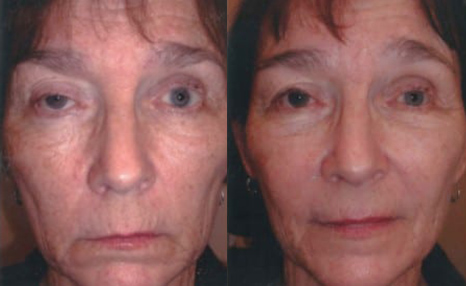 Blepharoplasty (Eyelid Surgery) before and after photo by Kristin J. Tarbet, M.D. in Bellevue, WA