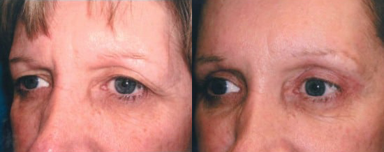 Blepharoplasty (Eyelid Surgery) before and after photo by Kristin J. Tarbet, M.D. in Bellevue, WA