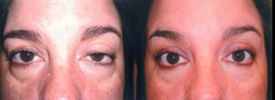Blepharoplasty (Eyelid Surgery) before and after photo by Kristin J. Tarbet, M.D. in Bellevue, WA