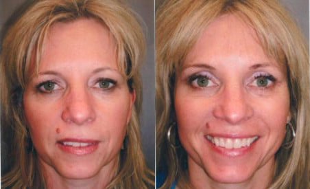 Blepharoplasty (Eyelid Surgery) before and after photo by Kristin J. Tarbet, M.D. in Bellevue, WA