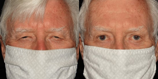 Blepharoplasty (Eyelid Surgery) before and after photo by Kristin J. Tarbet, M.D. in Bellevue, WA