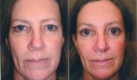 Blepharoplasty (Eyelid Surgery) before and after photo by Kristin J. Tarbet, M.D. in Bellevue, WA